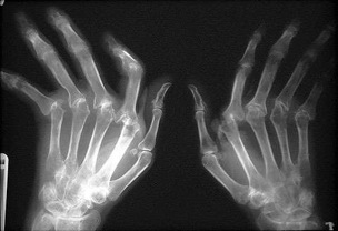 Rheumatoid Arthritis Hands XR